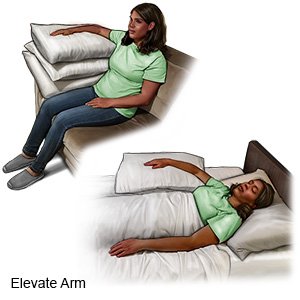 Elevate Arm - Female