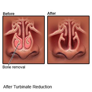After Turbinate Reduction