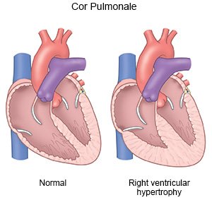 Cor Pulmonale