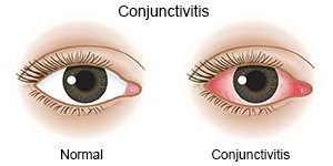 Conjunctivitis