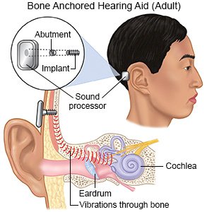Bone Anchored Hearing Aid (Adult)