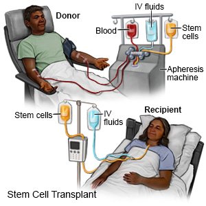 Stem Cell Transplant