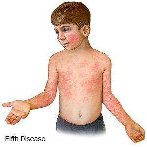 Fifth Disease