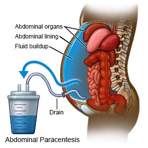 Abdominal Paracentesis