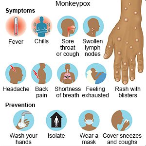 What Are the Symptoms of Monkeypox?