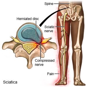 Sciatica Pain Relief - Take pressure off the sciatic nerve