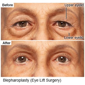 Blepharoplasty