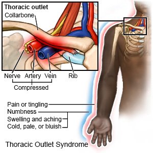 Thoracic Outlet Syndrome - What You Need to Know