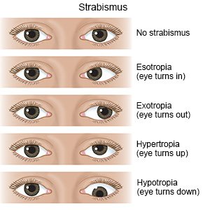 Strabismus