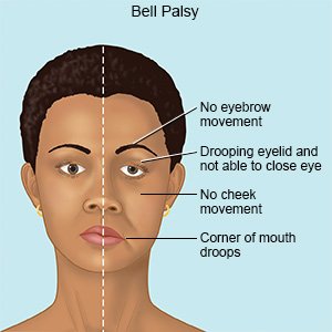 The Best Treatment For Bell's Palsy