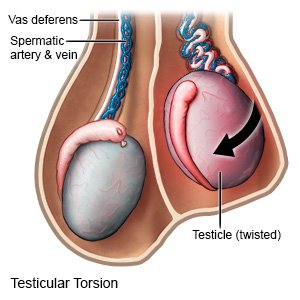 Testicular Torsion