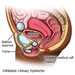 Inflatable Urinary Sphincter for Women