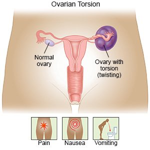 intermittent ovarian torsion