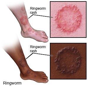 Tinea Corporis Ringworm Tinea Circinata Academic Dermatology Of Images