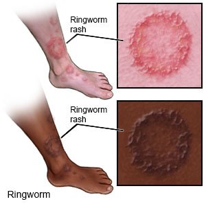 Ringworm