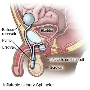 Inflatable Urinary Sphincter for Men