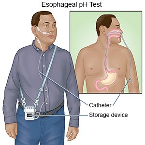 Esophageal pH Test