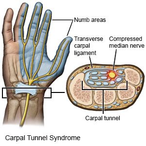 Carpal Tunnel Syndrome - What You Need to Know