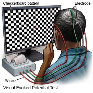 Visual Evoked Potential Test