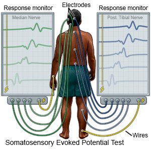 Somatosensory Evoked Potential Test