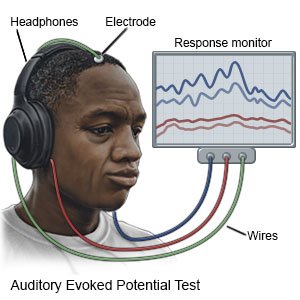 Auditory Evoked Potential Test