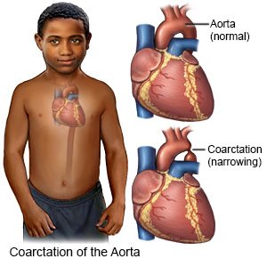 Coarctation of the Aorta