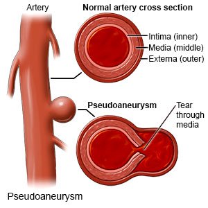 Pseudoaneurysm