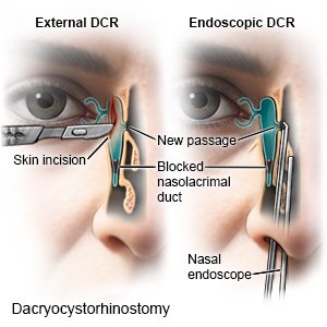 Dacryocystorhinostomy