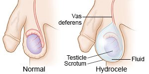 Hydrocele