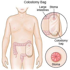 Colostomy Bag