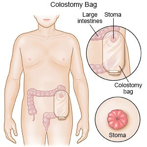 ostomate COLOSTOMY BAG Vomit Bag Price in India - Buy ostomate COLOSTOMY BAG  Vomit Bag online at Flipkart.com