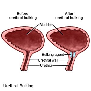 Urethral Bulking