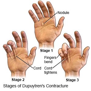 Stages of Dupuytren Contracture
