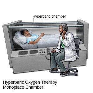 Hyperbaric Oxygen Therapy Monoplace Chamber