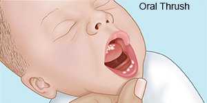 Oral Thrush