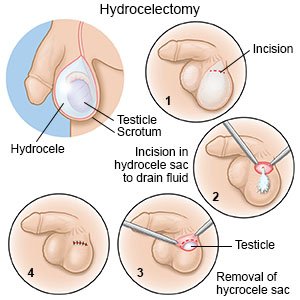 Hydrocelectomy