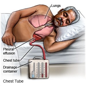 Chest Tube