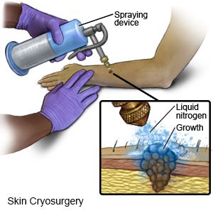 Skin Cryosurgery