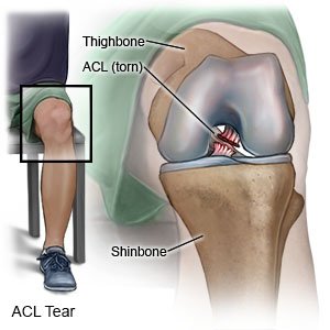 Posterior Cruciate Ligament Injury Treatment