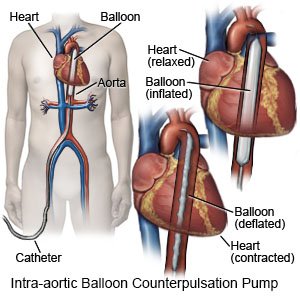 Intra-aortic Balloon Counterpulsation Pump
