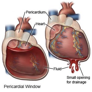 Pericardial Window
