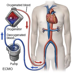 ECMO