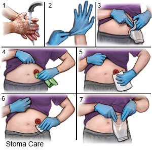 Stoma Care