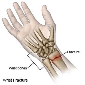 Wrist Fracture