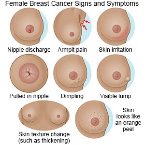 Female Breast Cancer Signs and Symptoms