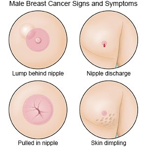 Male Breast Cancer Signs and Symptoms