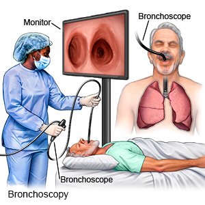 Bronchoscopy