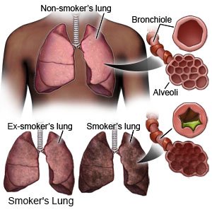 Smokers Lung