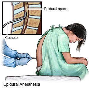 Epidural Anesthesia