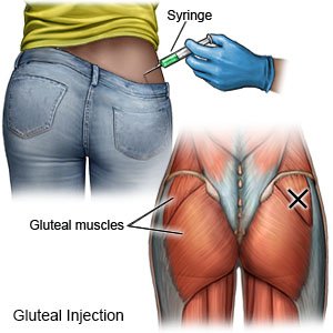 Gluteal Injection